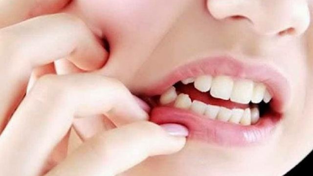 cara mengatasi gigi kuning